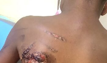 Mother burns son for losing pen