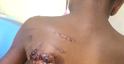 Mother burns son for losing pen